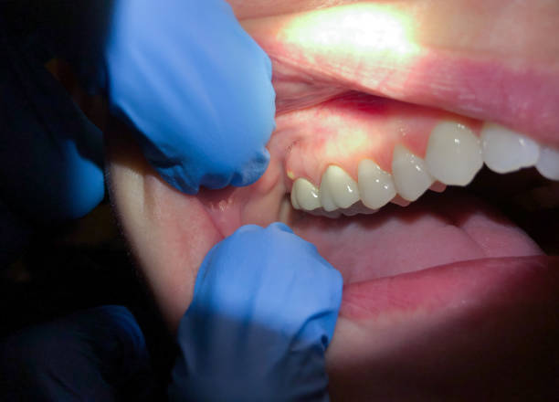Best Dentist for Tooth Abscess  in Dwight, IL